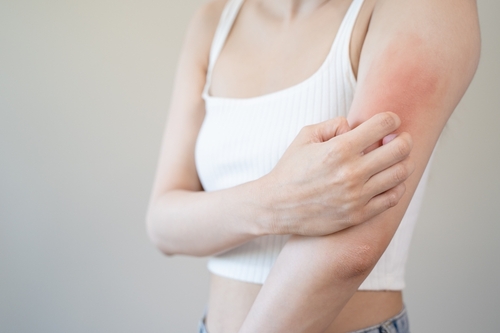 Female suffering from itchy rash and skin irritation.